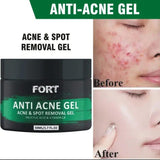 Fort Anti Acne Gel For Acne & Spot Removal